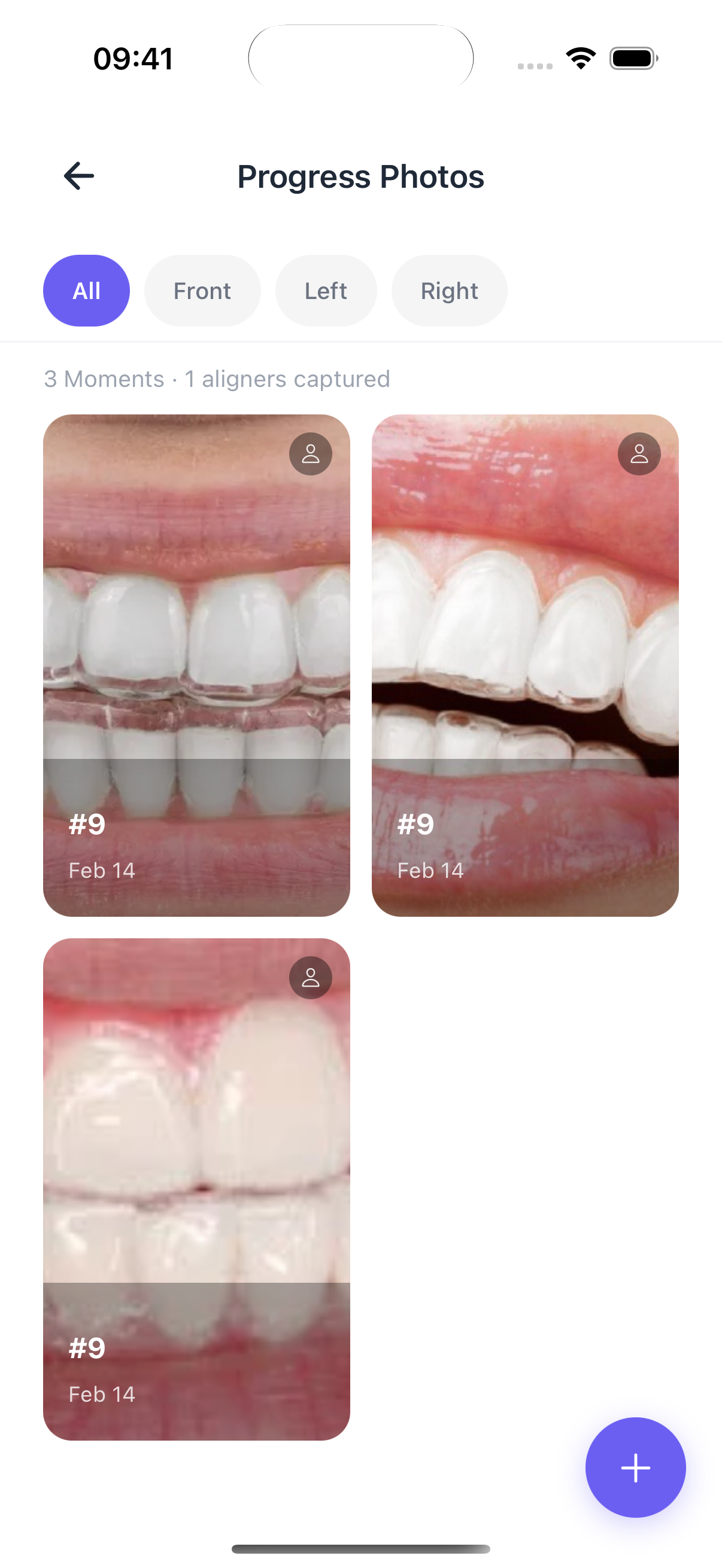 Progress photos organized by aligner and angle
